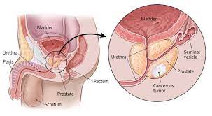 Prostate Cancer Treatment