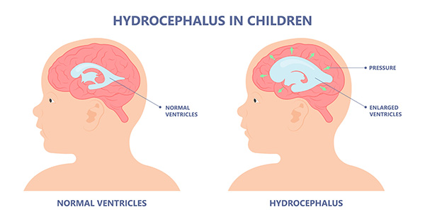 Hydrocephalus Treatment