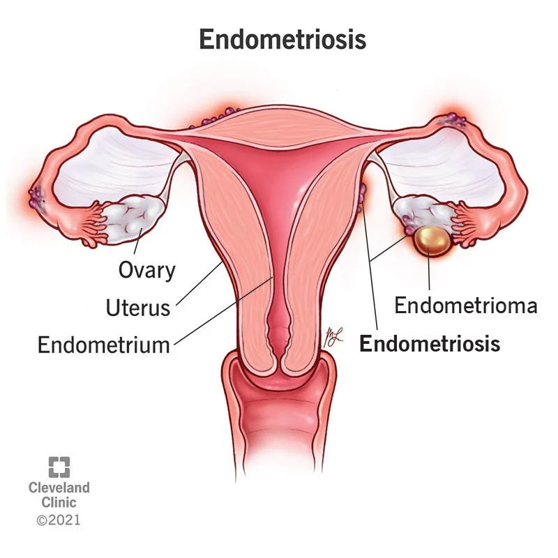 Endometriosis Treatment