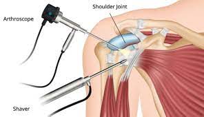 Shoulder Laparoscopy